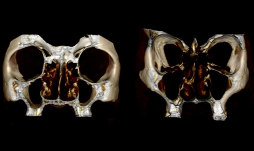 Khoa học lý giải tại sao mũi ta tẹt, mũi tây cao