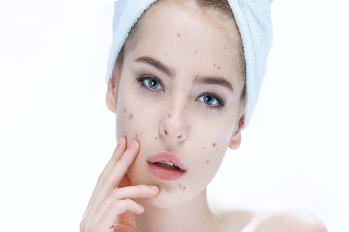 Bất ngờ với những cách trị mụn đơn giản