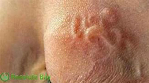 Khánh Hòa: Bùng phát bệnh sán chó