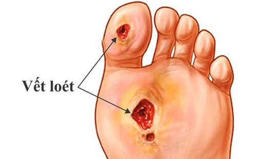 Chuyên gia khuyên: Muốn tránh xa bệnh tiểu đường, phải chú ý làm 4 điều này trước