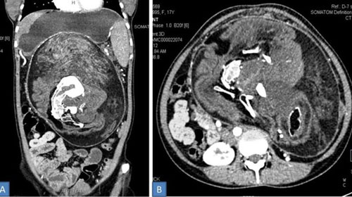 Thai nhi sống 'ký sinh' bên trong bụng cô gái 17 tuổi: Không phải con, đó chính là người em song sinh của cô ấy