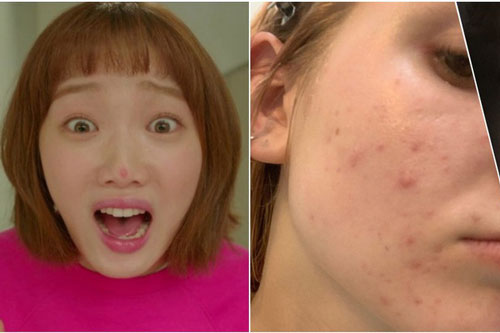 Bạn hay bị mụn ở vị trí nào? Bác sĩ sẽ chỉ ra nguyên nhân và cách chữa trị chuẩn nhất