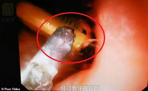 Nôn mửa liên tục kèm đau bụng, tới bệnh viện nhận tin sốc từ bác sĩ