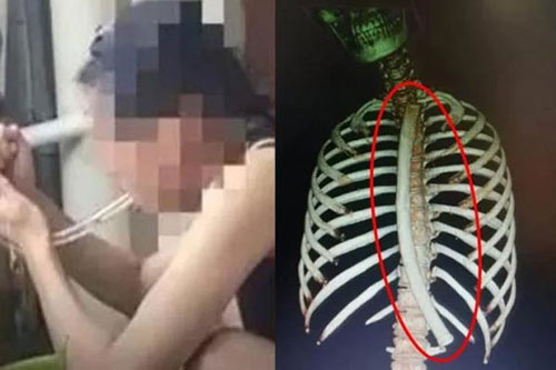 Gặp nạn vì giảm cân bằng... ống nhựa