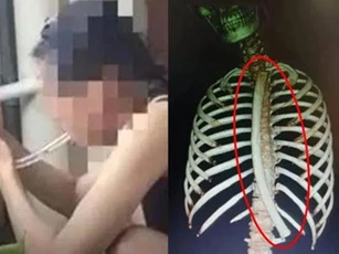 Gặp nạn vì giảm cân bằng... ống nhựa