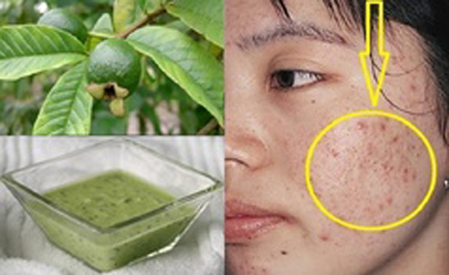 Lấy nắm lá ổi làm theo cách này, mụn đầu đen sẽ bị đánh bật nhanh chóng trả lại làn da trắng mịn như mơ