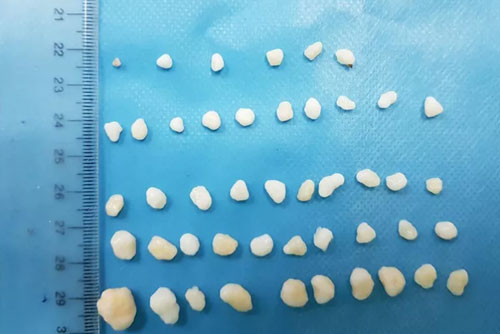 Lấy 45 viên sỏi màu trắng trong... khớp vai