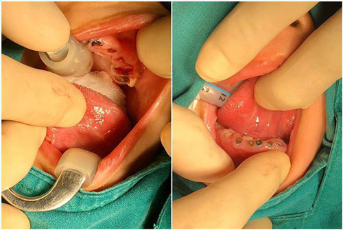 Cha mẹ bỏ bê chú ý, bé trai 4 tuổi phải nhổ toàn bộ hàm răng