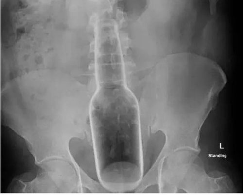 "Gãi ngứa" quá đà, chui tọt chai nước vào trực tràng