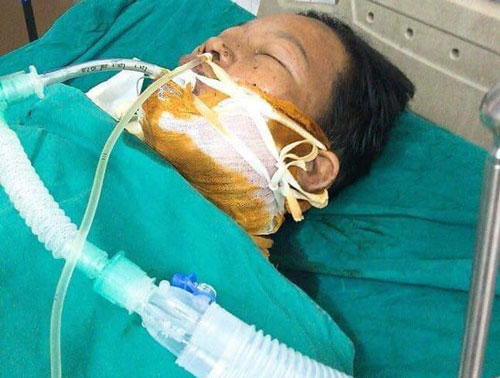 Nghệ An: Nổ can xăng, 2 vợ chồng bỏng nặng