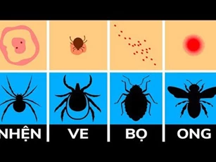 CLIP: Cách xác định và xử lý vết côn trùng đốt