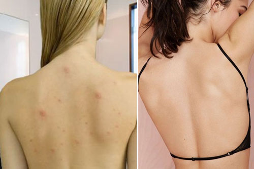 3 cách làm sạch mụn ở lưng vô cùng đơn giản
