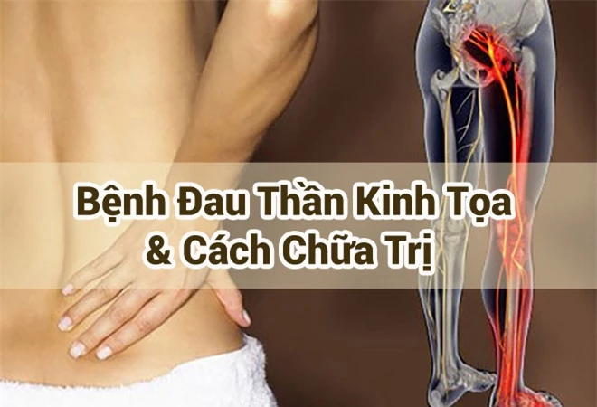 Đau thần kinh tọa: Triệu chứng và bài thuốc chữa trị hiệu quả tư vấn bởi chuyên gia - 1