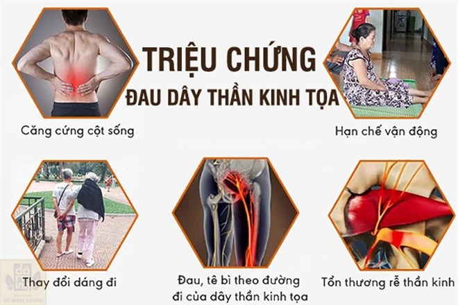 Đau thần kinh tọa: Triệu chứng và bài thuốc chữa trị hiệu quả tư vấn bởi chuyên gia - 2