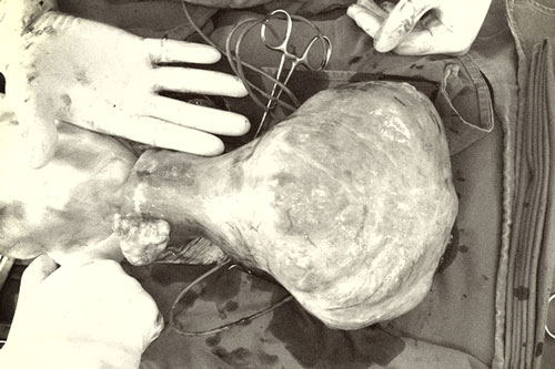 Bắc Giang: Đau bụng, rối loạn kinh nguyệt lâu ngày, vào viện phát hiện khối u xơ hơn 3kg