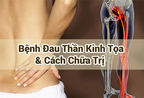 Đau thần kinh tọa và những điều cần biết