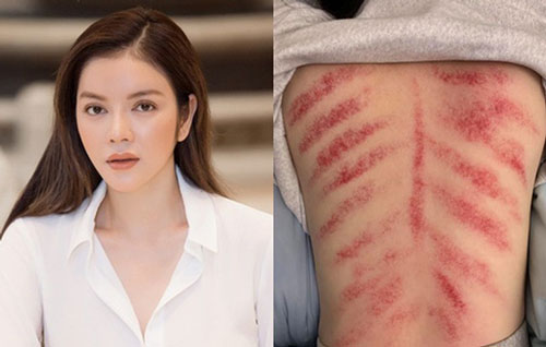Lý Nhã Kỳ bất ngờ đăng tải ảnh tấm lưng đầy vết đỏ ửng kéo dài, bạn bè nghệ sĩ đồng loạt để lại bình luận lo lắng
