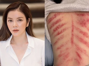 Lý Nhã Kỳ bất ngờ đăng tải ảnh tấm lưng đầy vết đỏ ửng kéo dài, bạn bè nghệ sĩ đồng loạt để lại bình luận lo lắng