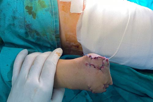 Lên mạng học chế tạo pháo, trẻ 13 tuổi bị cụt tay