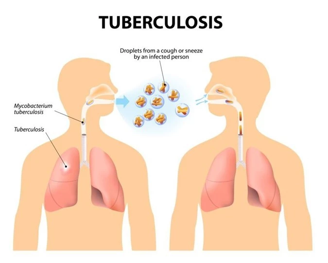 Lao phổi: Triệu chứng đặc thù của bệnh lao phổi là ho dữ dội, suy nhược cơ thể, ho ra máu, đổ mồ hôi khi ngủ và sụt cân. Đây là một bệnh có tính lây lan cao và cần điều trị bằng kháng sinh mạnh trong 6 đến 12 tháng.