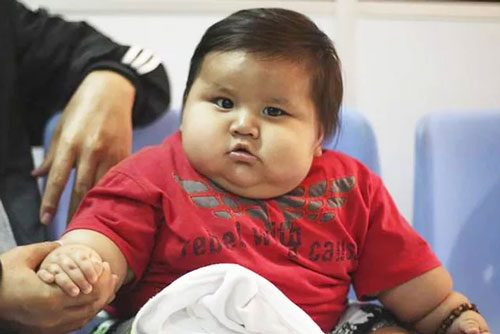 Béo phì có liên quan đến tổn thương não ở trẻ em và thanh thiếu niên