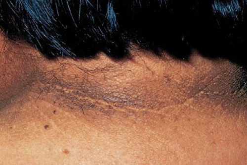 Hình minh họa (Ảnh: Fitzpatrick’s Dermatology).