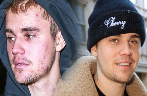 Bao năm bị tố lạm dụng ma tuý đá, Justin Bieber tiết lộ tình trạng bệnh tình thật sự khiến nhan sắc "tàn tạ"