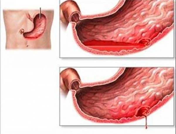 Cảnh báo chảy máu dạ dày bởi món ăn vặt phổ biến mùa lạnh - Ảnh 4