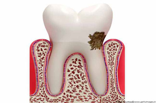 Top nguyên nhân phổ biến gây các vấn đề về răng miệng