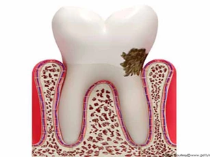 Top nguyên nhân phổ biến gây các vấn đề về răng miệng