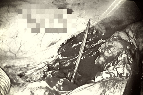 Đau, chướng bụng kéo dài do tăm đâm thủng ruột mà không hay biết