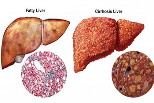 Những biểu hiện cảnh báo gan bạn đang "kêu cứu"