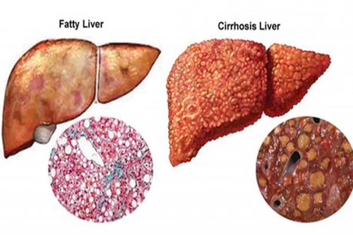 Bệnh gan nguy hiểm.