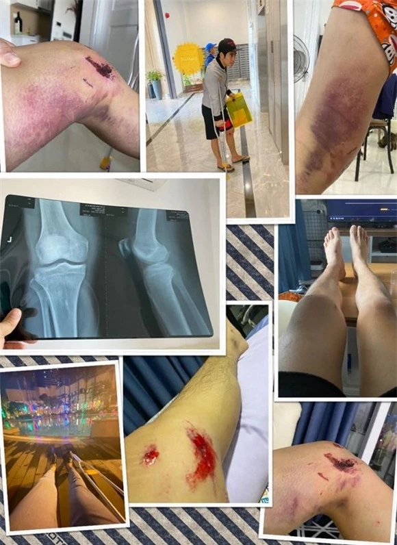 Thanh Bình đã khiến người hâm mộ lo lắng khi đăng bức ảnh anh nằm viện với nhiều vết thương ở chân. Diễn viên Thanh Bình bị trật khớp vai, dập sườn số 3, chân trái đa chấn thương từ trên xuống dưới sau vụ tai nạn.