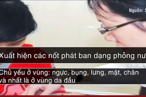 Nguy cơ bệnh thủy đậu tăng nhanh sau Tết