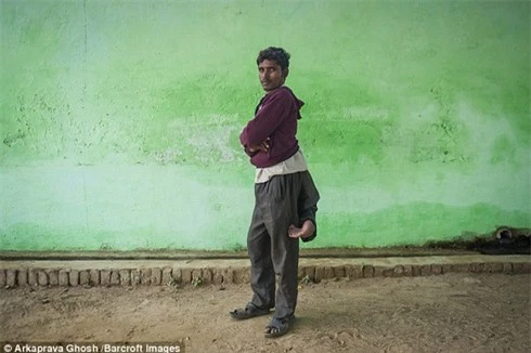 Chàng trai Ấn Độ khốn khổ vì sống chung với 4 chân - ảnh 2