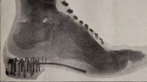 Đo cỡ giày bằng máy chụp X-quang từng là xu hướng thời thượng vì sức khỏe