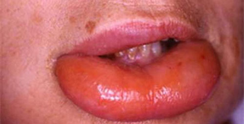 Ớn lạnh với hình ảnh dị ứng thuốc