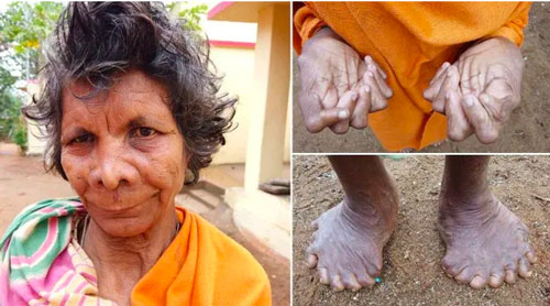 Gặp người phụ nữ có 31 ngón tay chân, được lưu danh vào kỷ lục Guinness 