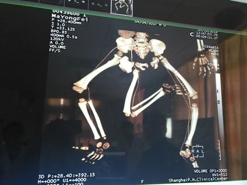Phim chụp x-quang của bé ba chân ở Tân Cương, Trung Quốc
