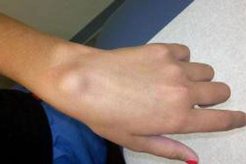 Thấy tay có dấu hiệu này đến viện ngay kẻo hối hận thì đã quá muộn