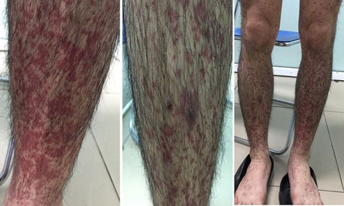 Xuất huyết toàn bộ tay chân sau khi ăn hải sản