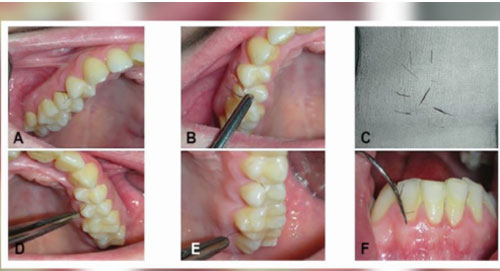 Mắc bệnh lạ, người phụ nữ mọc lông ở lợi