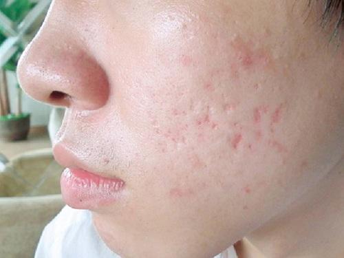 Có 3 cách này rồi sẹo lõm cứng đầu đến mấy cũng được lấp đầy