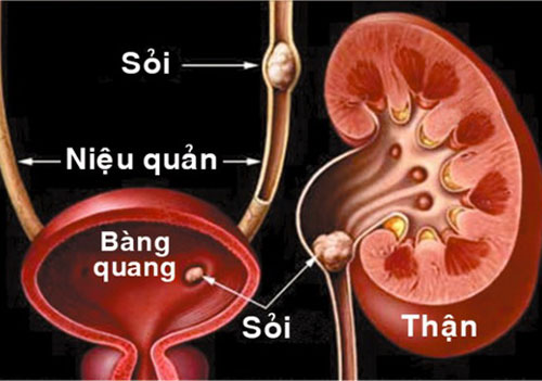 Bài thuốc phòng trị sỏi thận, tiết niệu