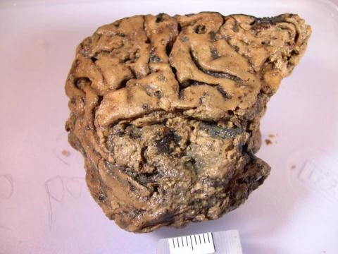 Bộ não được bảo tồn nguyên vẹn đến kinh ngạc sau 2.600 năm