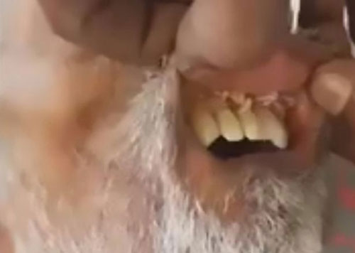 Giòi nhung nhúc trong miệng bệnh nhân đột quỵ