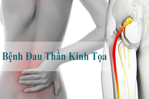 Bài thuốc dân gian trị đau thần kinh tọa triệt để