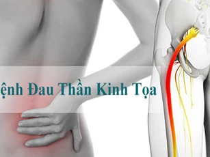 Bài thuốc dân gian trị đau thần kinh tọa triệt để