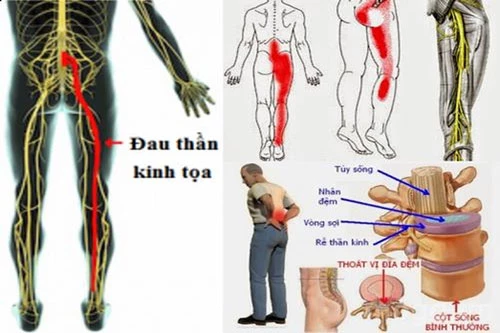 Đau thần kinh tọa ảnh hưởng nhiều đến chất lượng cuộc sống của bạn.